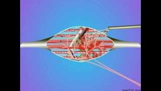 09_Trigger Point Dry Needling