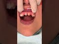 Can dental bridges look good  dental bridge procedure  missing front tooth fix  dr yazdan