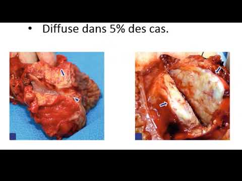 Cancer du pancreas Dr BELKADI Pr BOUBEKEUR