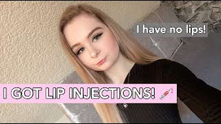 My Lip Injections Experience!🙊 *on very thin lips* / Lip Filler