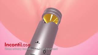 Download Lazerle İdrar Kaçırma Tedavisi Op. Dr. İlhami Atilgan Video MP3 Lazerle İdrar Kaçırma Tedavisi Op. Dr. İlhami Atilgan