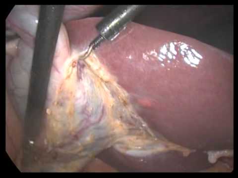 Lap  Cholecystectomy Unedited 382  Simple Chronic Cholecystitis Dilated GB