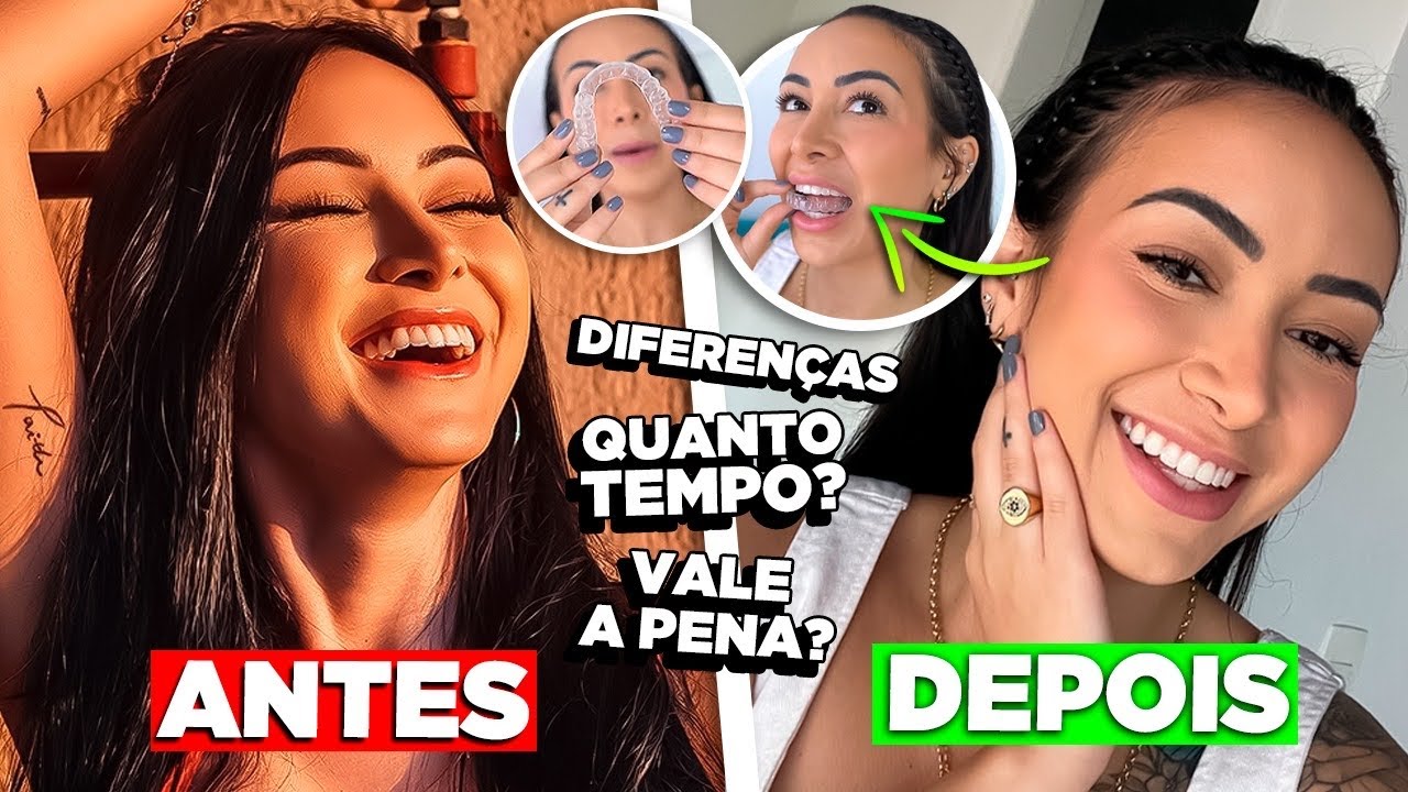 Finalizei meu tratamento com os alinhadores da SouSmile - VALEU À PENA MESMO?