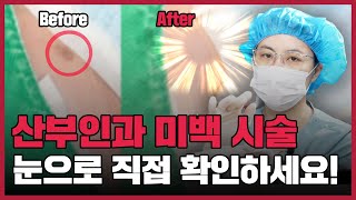 산부인과 미백 시술, 눈으로 확인한 Before &amp; After!
