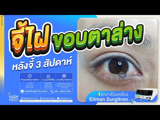 รีวิวตัดไฝ ขี้แมลงวัน EP.370/ จี้ไฝยังไงไม่ให้มีรอยแผลเป็น @หมอปุ๊ NeramitClinic