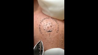 Satisfying nose pimple removal