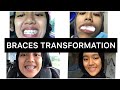 BRACES TRANSFORMATION | Fangten