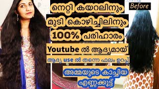 നെറ്റി കയറലിനും മുടി കൊഴിച്ചിലിനും 100% പരിഹാരം|Miracle Homemade Oil| Thick & Double Hair Growth Oil