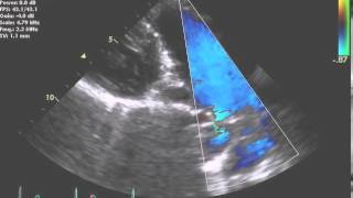 TTE Normal PLAX RV outflow color  Example 1