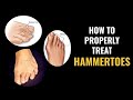 Hammertoes