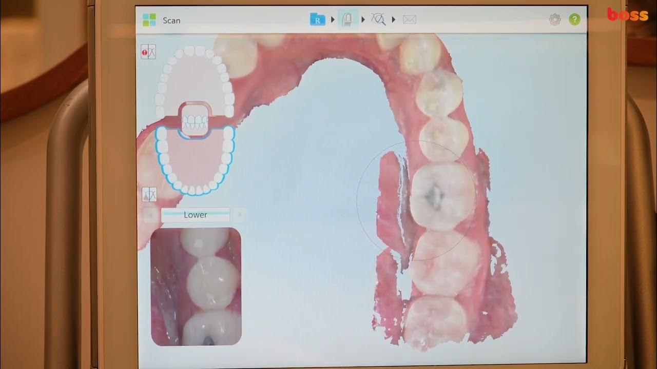 Orthodontic Records Itero Scanning for Clear Aligner Orthodontic