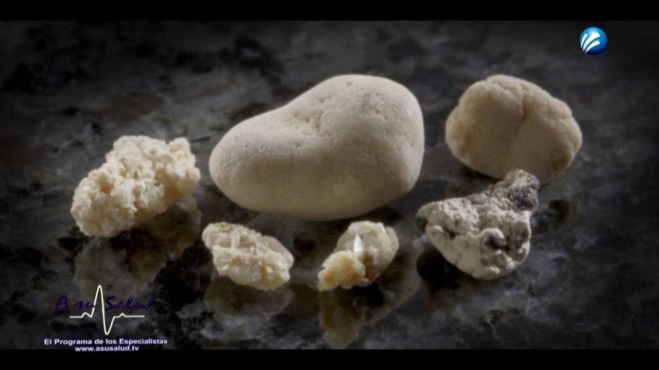 LItiais o nefrolitiasis; piedras en vias urinarias, Dr Mauricio Gallo, Urologo oncologo saludos amigos dvd