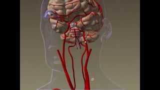 Stroke - Artery Clot