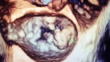 Mitral annular calcification (MAC), percutaneous valve intervention or surgery?