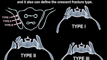 Crescent Fracture Of The Pelvis - Everything You Need To Know - Dr. Nabil Ebraheim