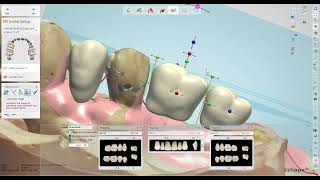 how to do a single tooth in the 3shape denture library