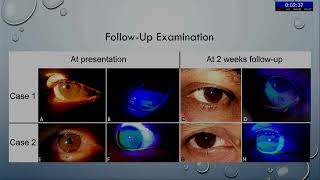 AIOCMT3 2024   UKFP28 topic Dr Prateek Nishant   Ocular Surface Inflammation following accidental ad