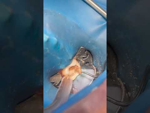 Root canal treatment for lower right molar tooth, tooth nerve #dentist