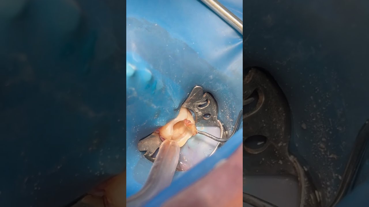 Root Canal Treatment For Lower Right Molar Tooth Nerve Dentist