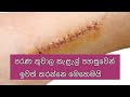 How to get rid of scars | තුවාල කැලැල් ගෙදරදීම සුව කරගමු