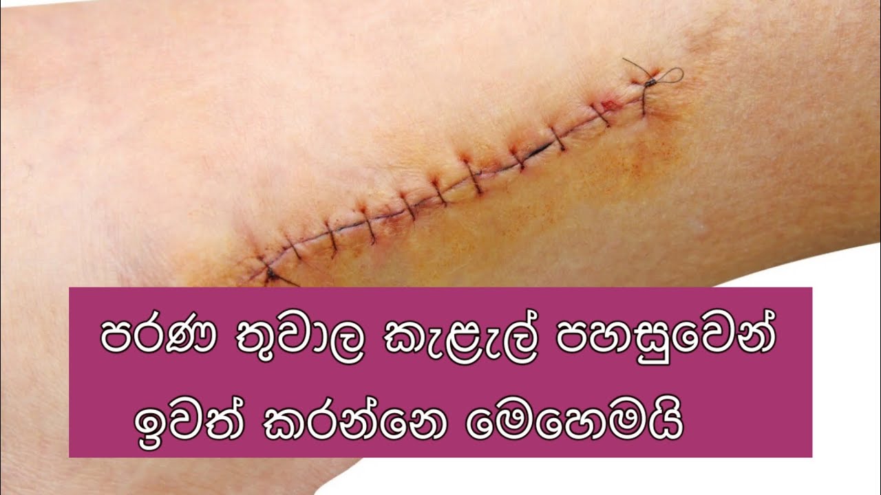 Download How to get rid of scars | තුවාල කැලැල් ගෙදරදීම සුව කරගමු