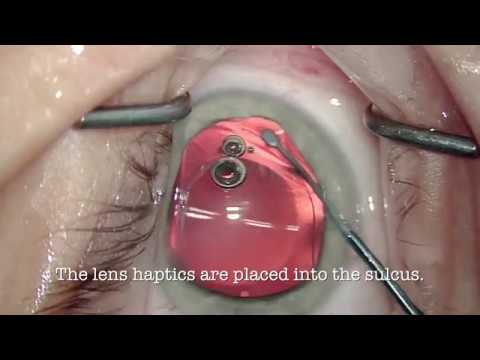 My Double Eye Surgery (ICL) - YouTube