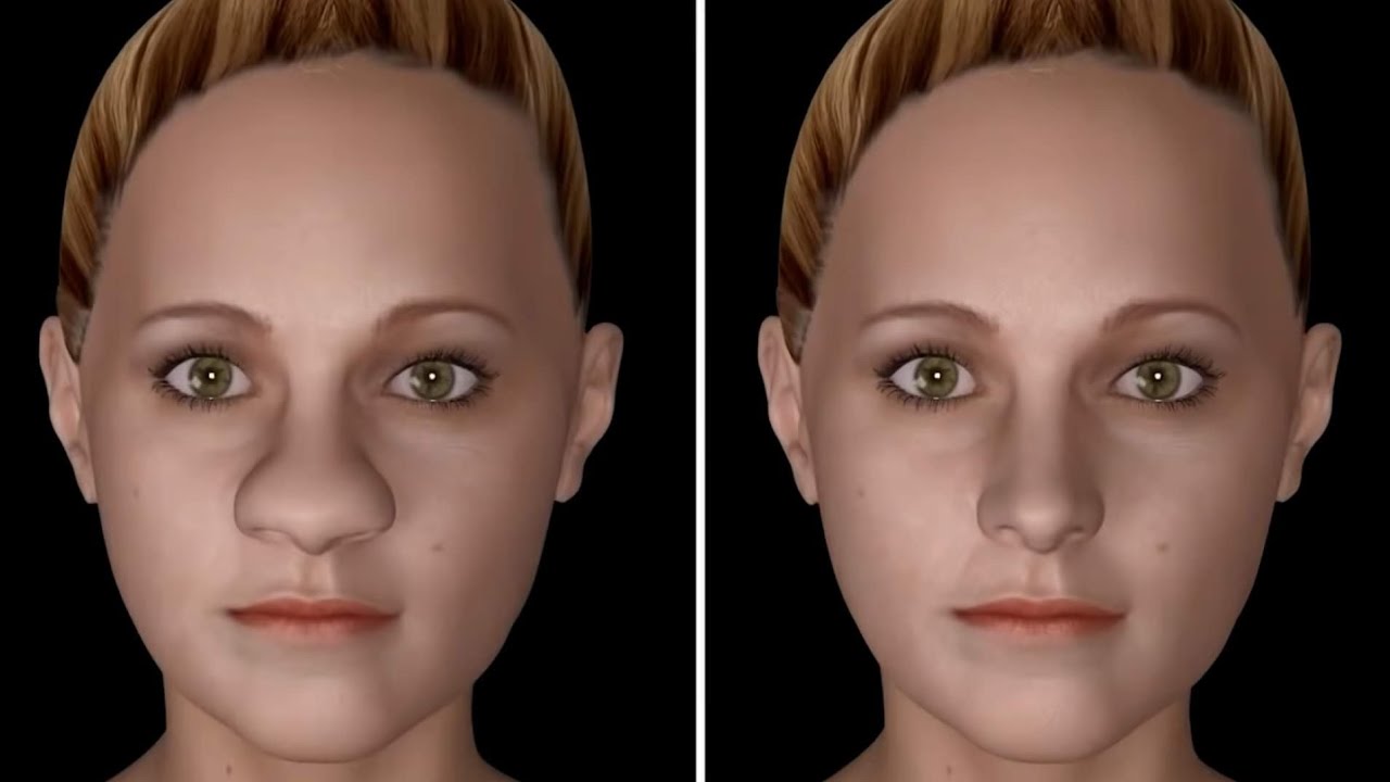 شاهد كيف تتم عمليه تصغير الأنف|كما لم تراها من قبل_rhinoplasty surgery