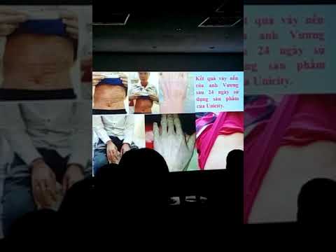 Video GIẢI PHÁP CHỮA DỨT ĐIỂM BỆNH VẢY NẾN NHỜ SẢN PHẨM CỦA... - youtube
