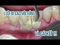 Cận cảnh cạo vôi răng, lấy cao răng lâu năm | White Dental