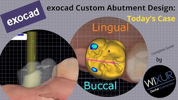 exocad Custom Abutment Design: Today