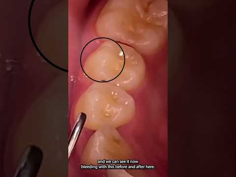 رسم بياني للنزيف على مسبار اختصاصي النظافة