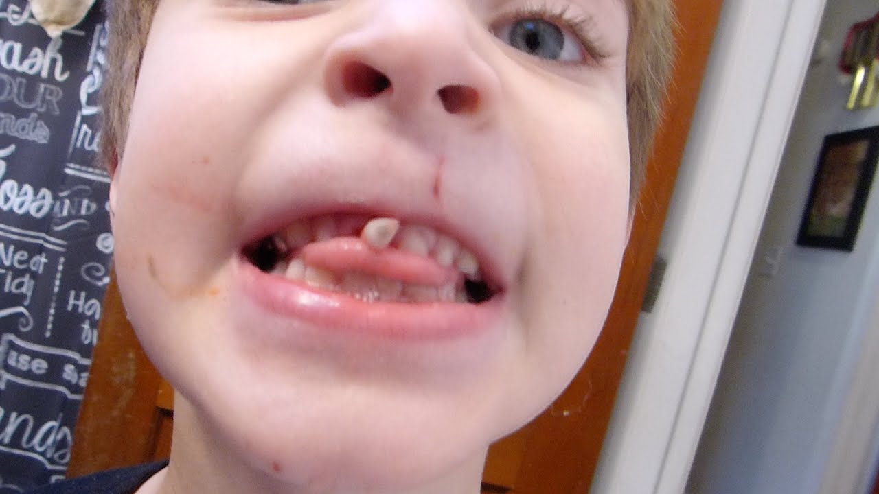 Ivan's NASTY loose tooth! Disgusting! Do not watch! - YouTube