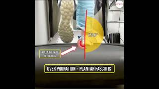 Uncover The Link Between Plantar Fasciitis And Over Pronation! #Healthtips #Feetfirst