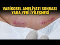 Varikosel Ameliyatı Sonrası Yara Yeri İyileşmesi Nasıl Olur?