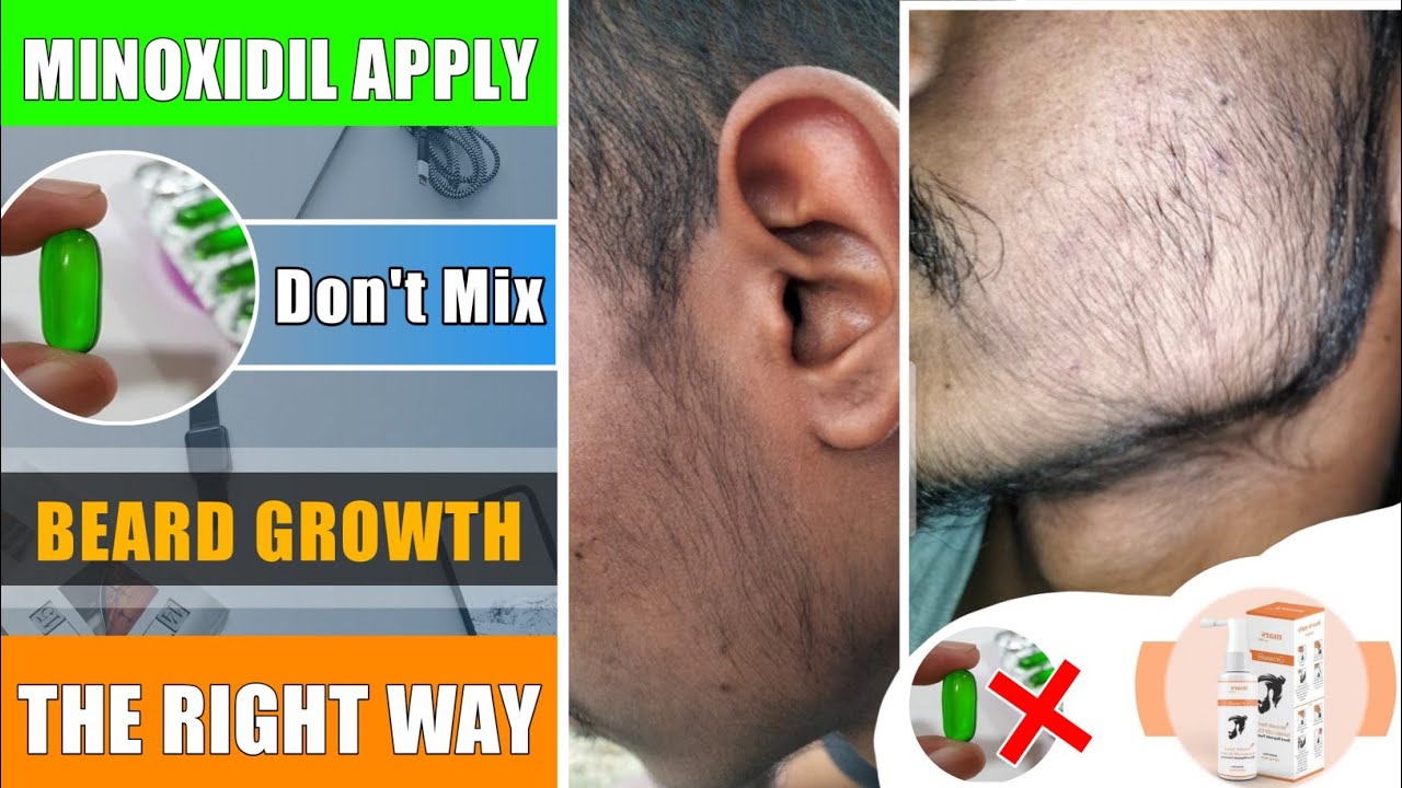 BEARD GROWTH ! Apply beard growth minoxidil ! Don't mix evion 400 ! Beard growth the right way