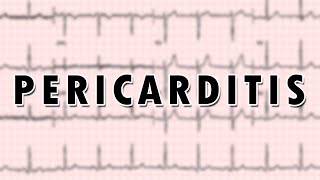 Pericarditis