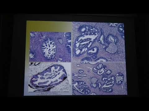 Βίντεο: In situ νεοπλασία γεννητικών κυττάρων;