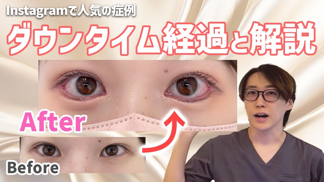 つり目が大きい目に！激変する過程を医師が解説【たれ目形成】