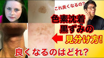 色素沈着 Youtube