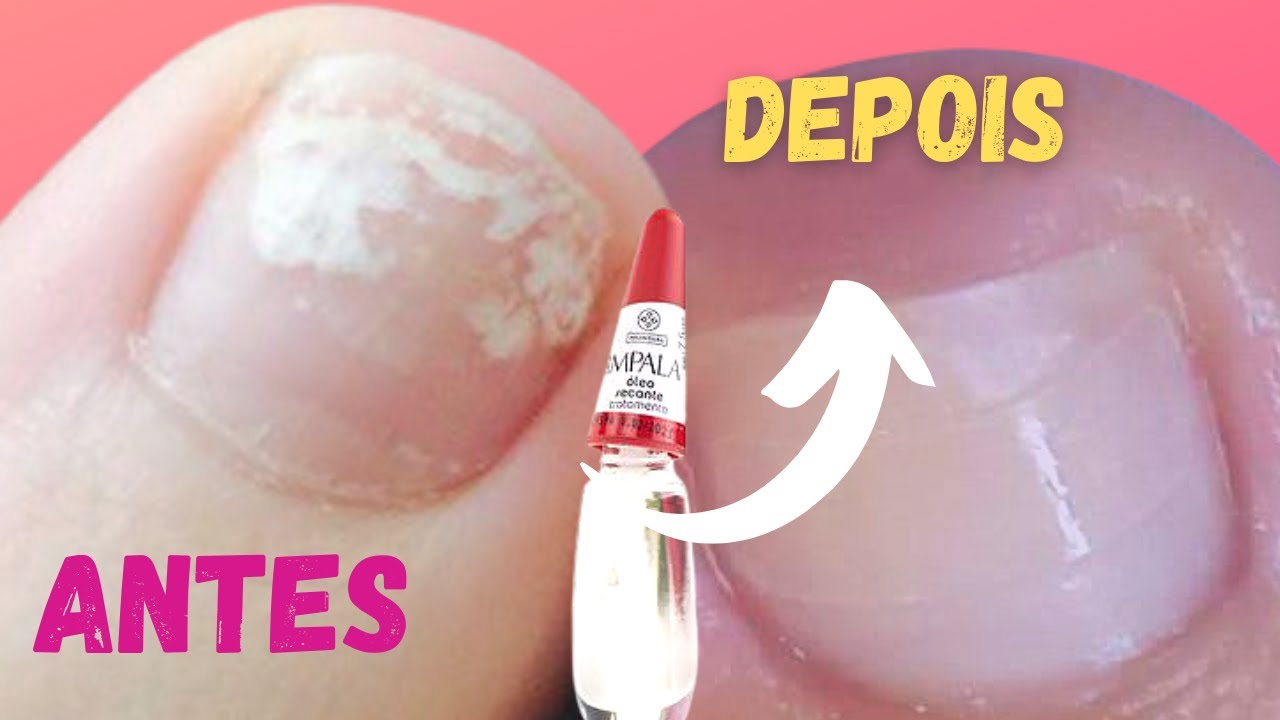 Como remover manchas brancas na unha - YouTube