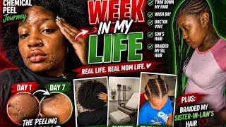 My Chemical Peel Journey (Day by Day) + Getting My Birth Control Removed | Weekly Vlog
