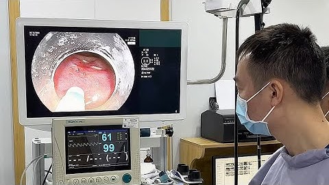 Can thiệp ung thư sớm thực quản. Tầm soát sớm ung thư cùng bác sĩ Trần Cảnh.