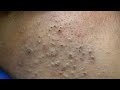 [ASMR] Deep Pore Cleansing: Blackheads Removal &amp; Skin Care Routine