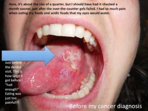 Tongue Cancer, Squamous Cell Carcinoma in Young People, Do you have it? Survive It!