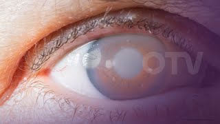 يوم جديد - إرتفاع ضغط العين (الماء السوداء/Glaucoma)