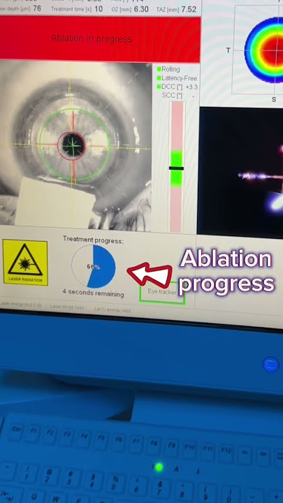 How fast is the excimer laser?