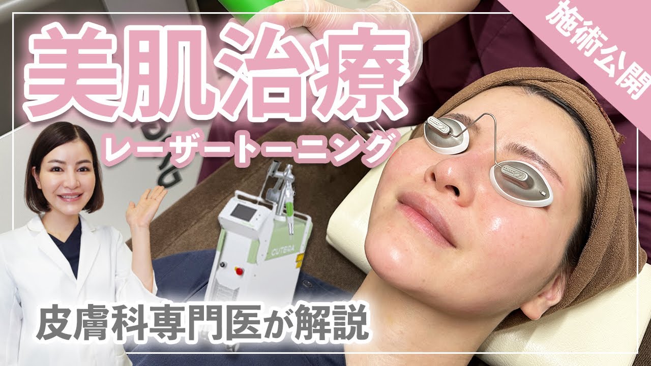 【シミ治療】レーザートーニングを体験！必要回数・痛み・ダウンタイムは？【皮膚科専門医】