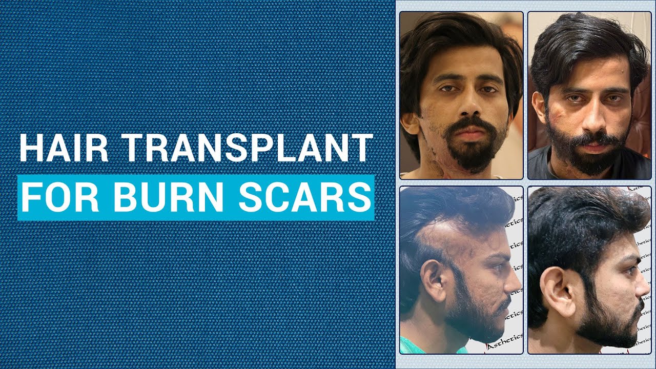 Burn Scar Hair Transplant | Dr. Jawad Jahangir | JJ Aesthetics | Pakistan's Best Doctor