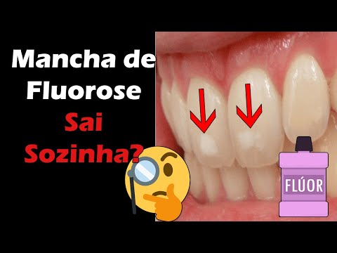 Vídeo: A Razão Para O Aparecimento De Manchas Brancas Nos Dentes De Uma Criança