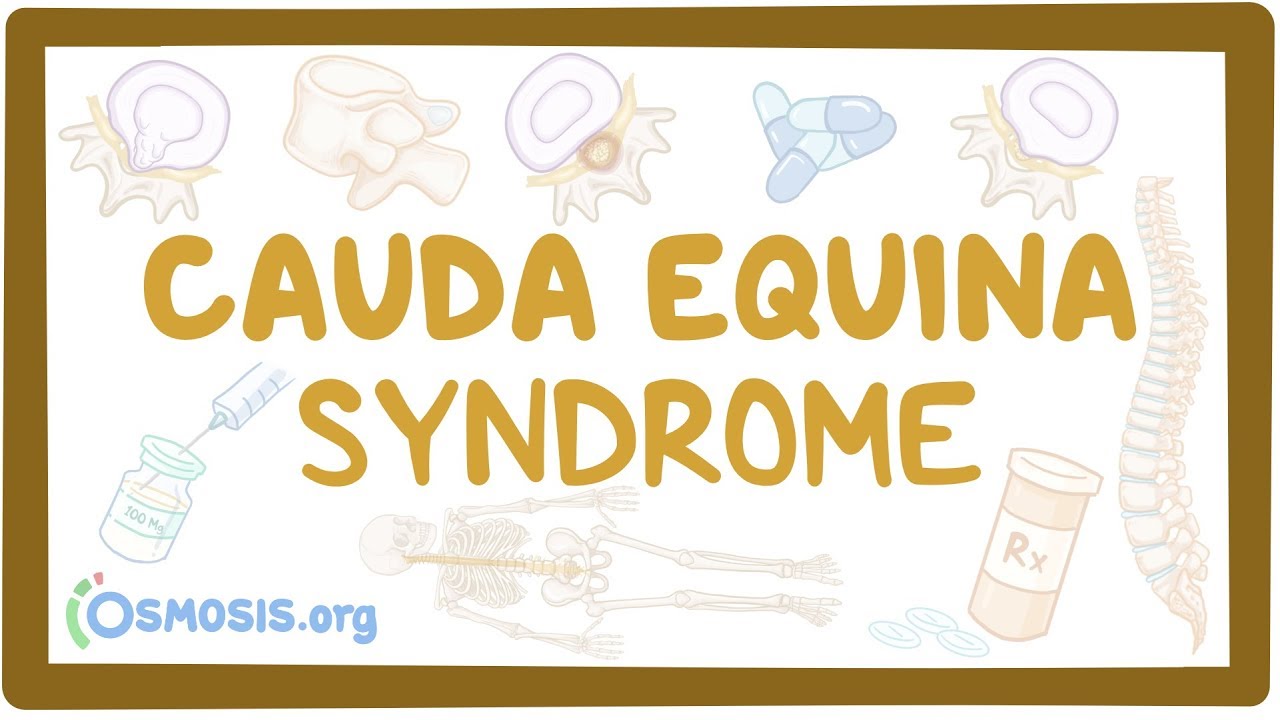 Cauda equina syndrome osmosis 会社